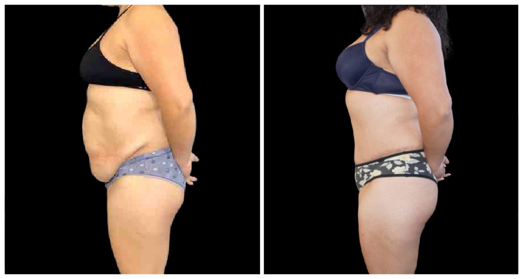 360° Contouring - Body Contouring in London Ontario before and after result