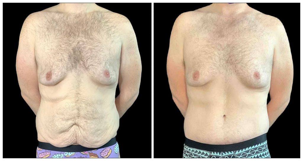 360° Contouring - Body Contouring in London Ontario before and after result