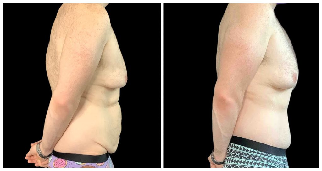 360° Contouring - Body Contouring in London Ontario before and after result