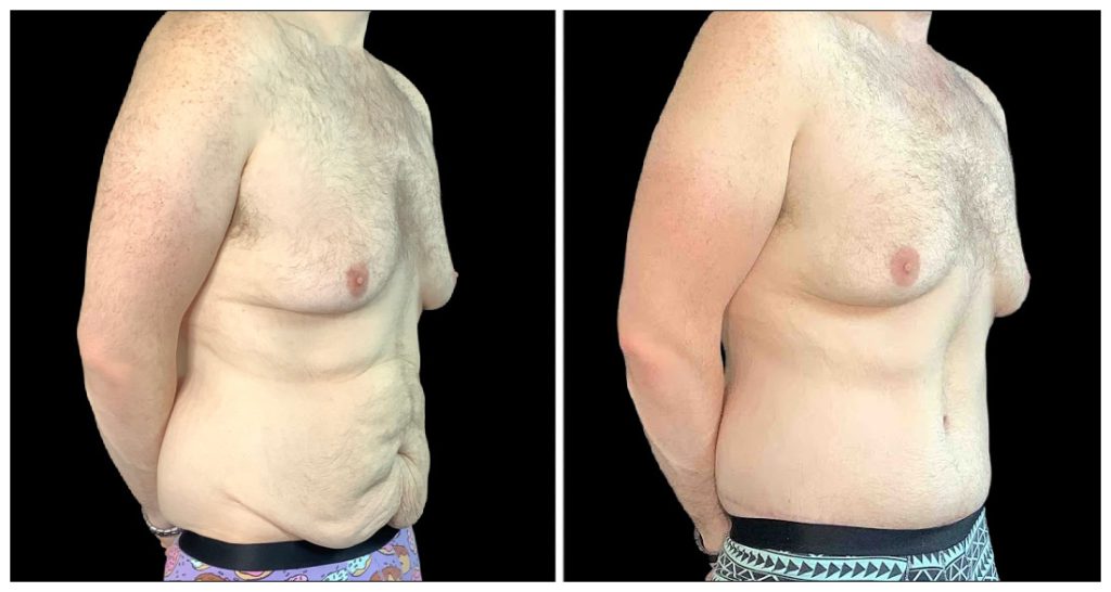 360° Contouring - Body Contouring in London Ontario before and after result