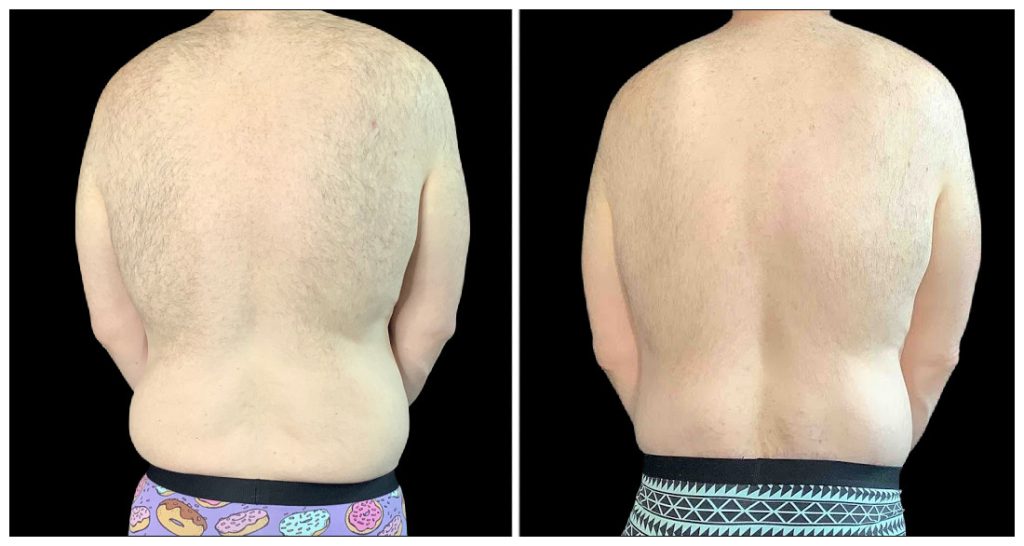 360° Contouring - Body Contouring in London Ontario before and after result