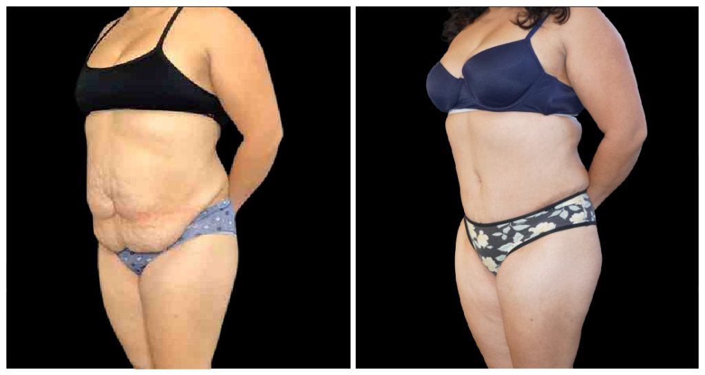 360° Contouring - Body Contouring in London Ontario before and after result
