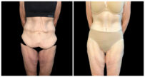 360° Contouring - Body Contouring in London Ontario before and after result
