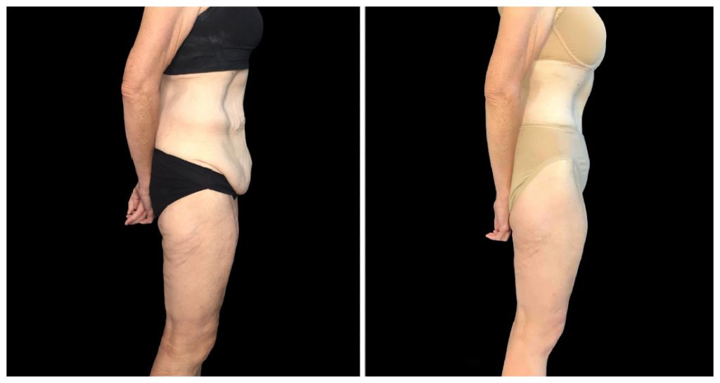 360° Contouring - Body Contouring in London Ontario before and after result