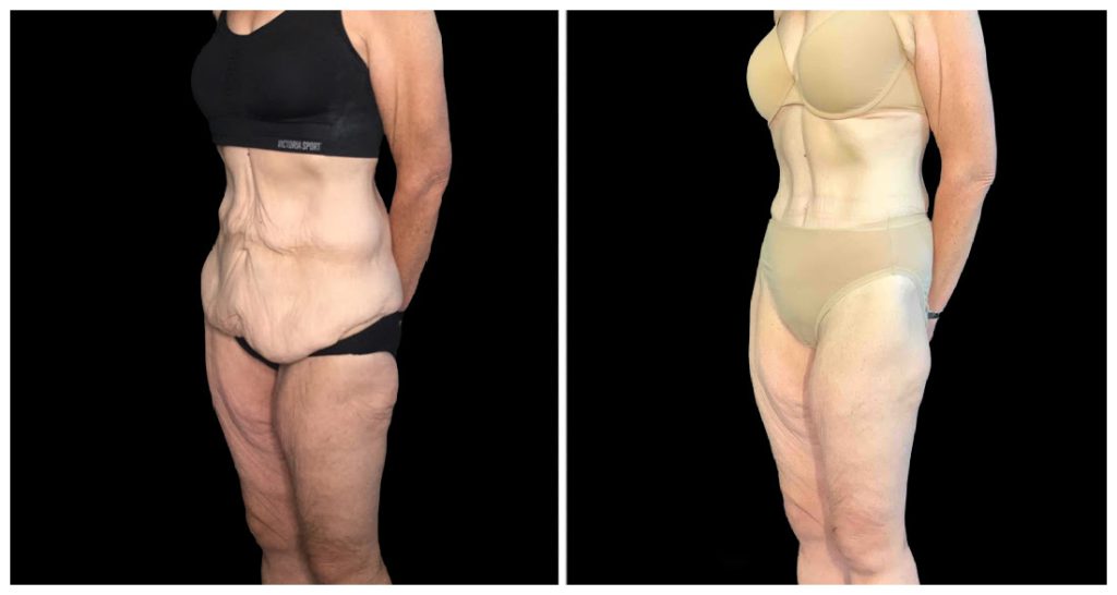 360° Contouring - Body Contouring in London Ontario before and after result