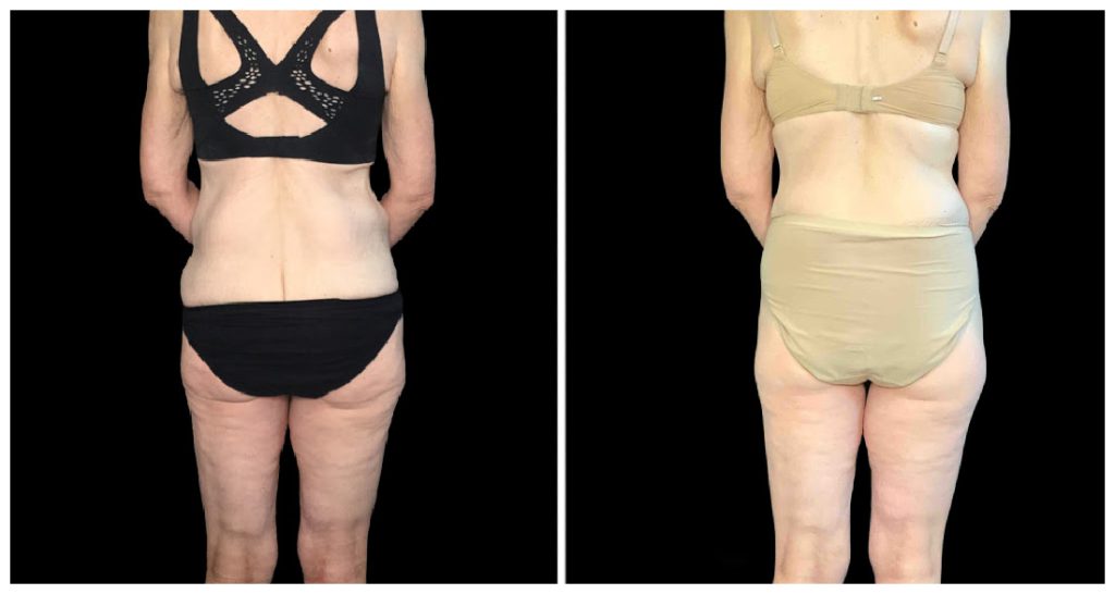 360° Contouring - Body Contouring in London Ontario before and after result