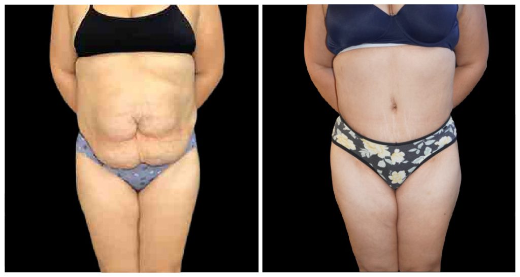 360° Contouring - Body Contouring in London Ontario before and after result