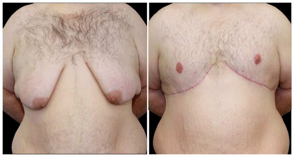 360° Contouring - Body Contouring in London Ontario before and after result