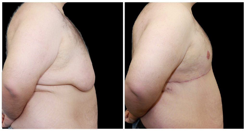 360° Contouring - Body Contouring in London Ontario before and after result