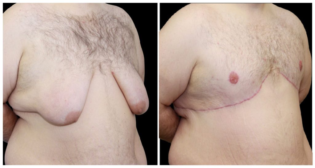 360° Contouring - Body Contouring in London Ontario before and after result