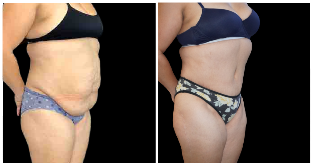 360° Contouring - Body Contouring in London Ontario before and after result