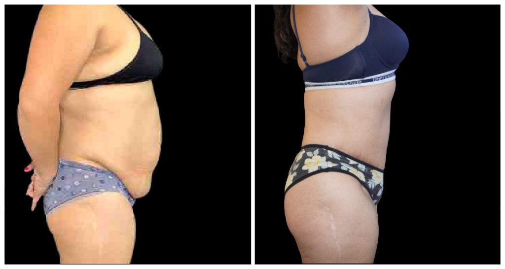 360° Contouring - Body Contouring in London Ontario before and after result