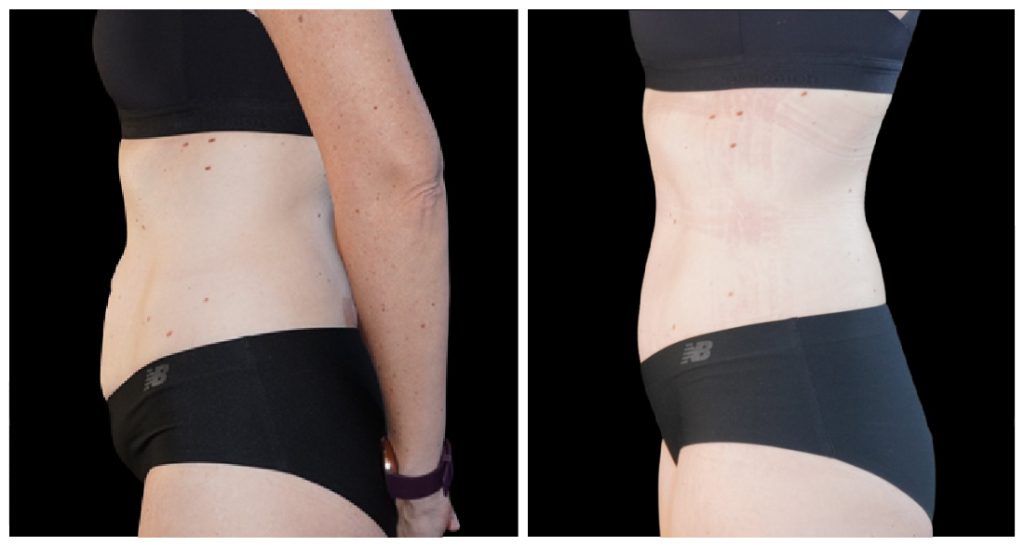 Side view of a woman's torso showing before and after results of a body contouring procedure, highlighting changes in waist and abdominal area.