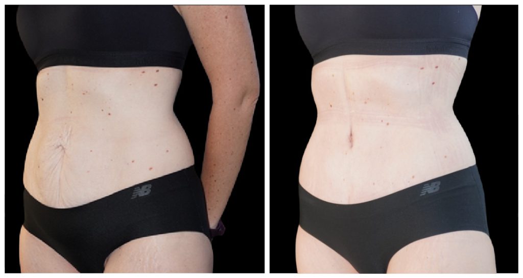 Before and after images of a woman's abdomen showing changes in skin texture and appearance. The left side displays stretch marks, while the right side shows smoother skin.