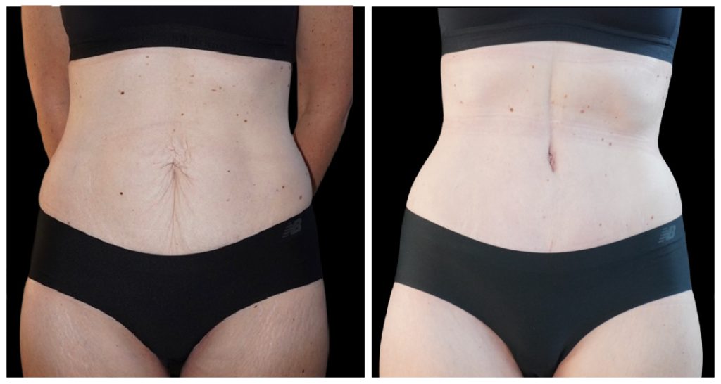 Before and after images of an abdominal area showing changes in skin texture and appearance, presented in a neutral setting.
