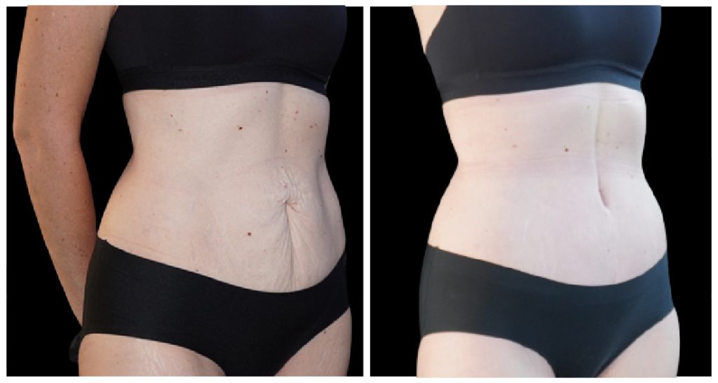 Tummy Tuck London Ontario before and after result