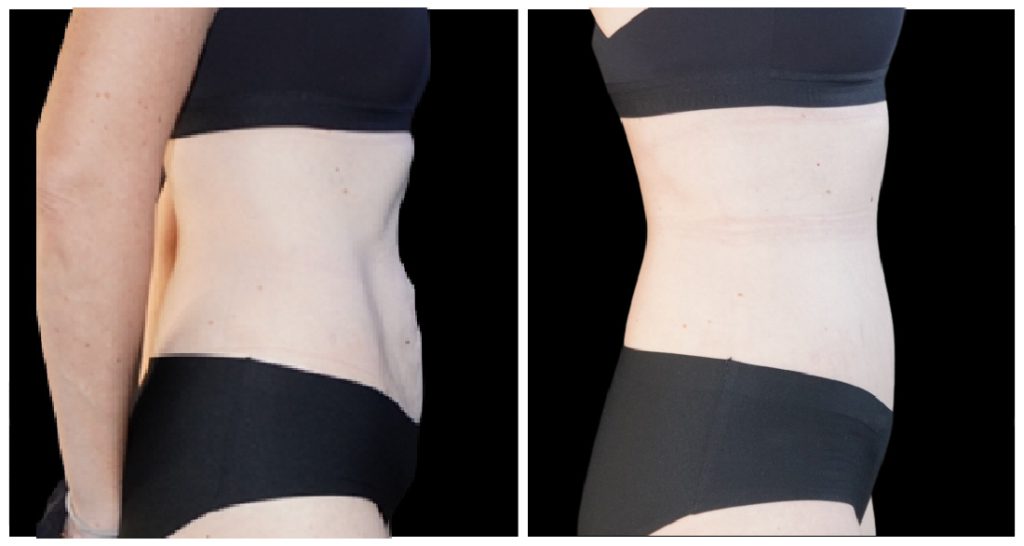 Before and after images showing the side profile of a person's torso, highlighting changes in body contour and shape.