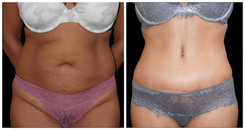 Tummy Tuck London Ontario before and after result