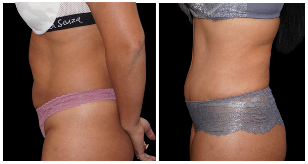Tummy Tuck London Ontario before and after result