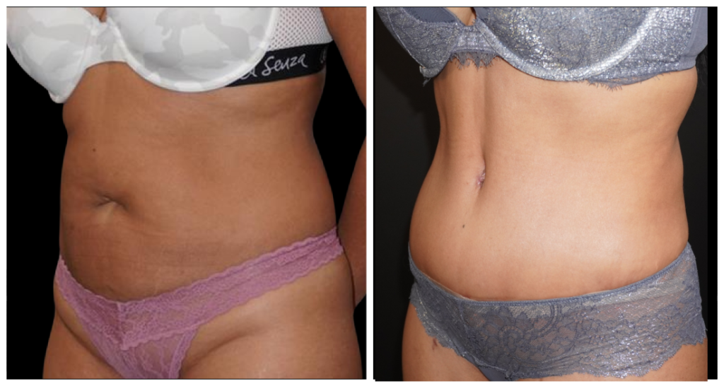 Tummy Tuck London Ontario before and after result
