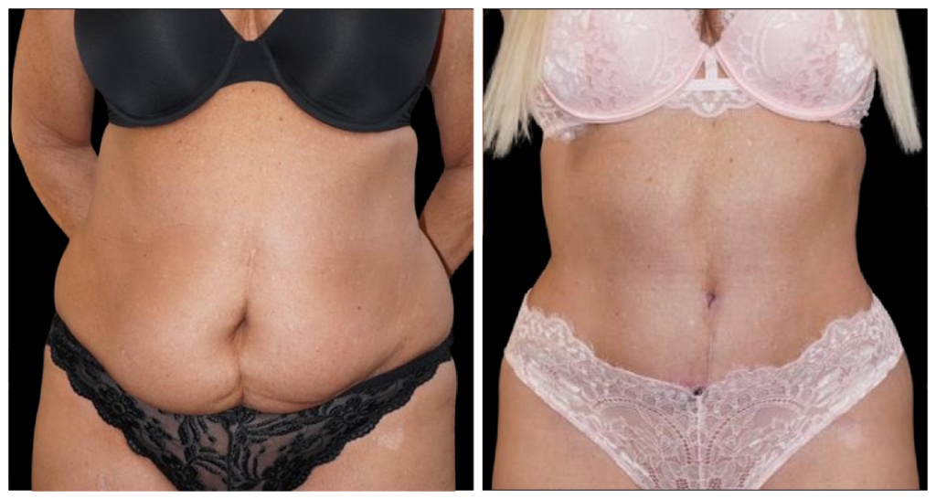Tummy Tuck London Ontario before and after result