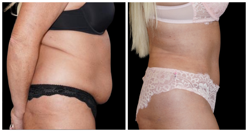 Tummy Tuck London Ontario before and after result