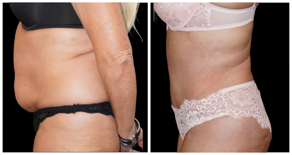 Tummy Tuck London Ontario before and after result