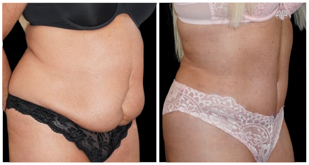 Tummy Tuck London Ontario before and after result