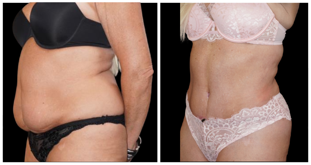 Tummy Tuck London Ontario before and after result
