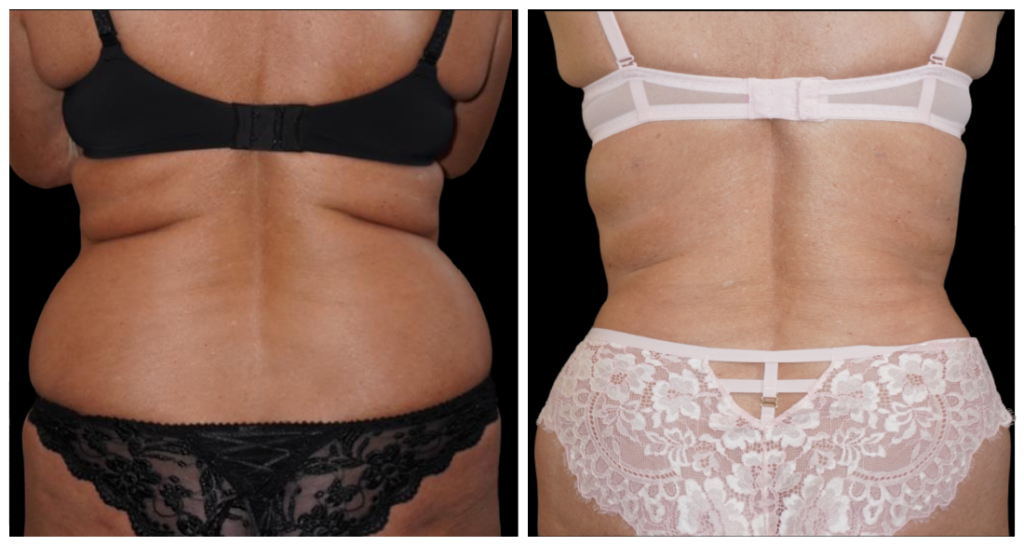 Tummy Tuck London Ontario before and after result