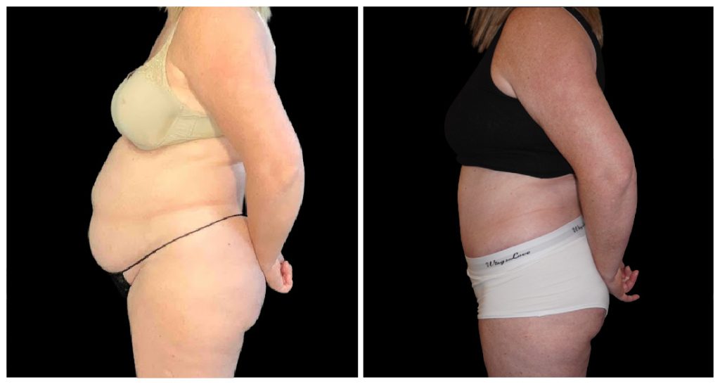 Tummy Tuck London Ontario before and after result