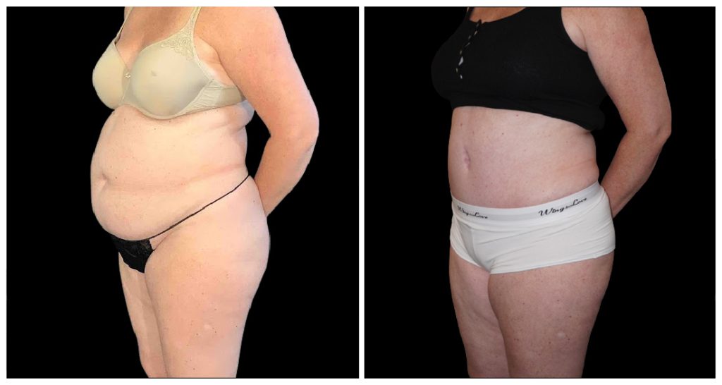 Tummy Tuck London Ontario before and after result