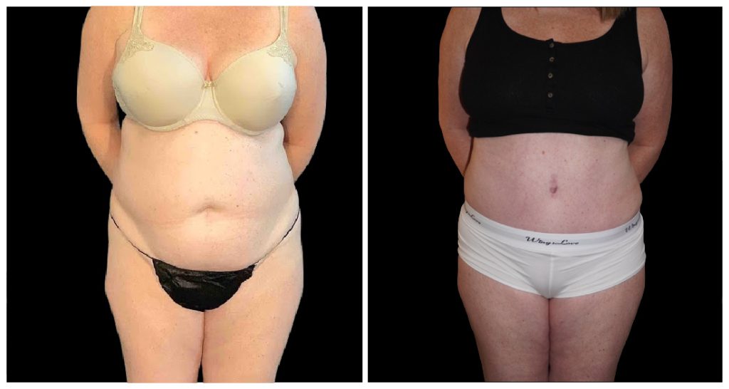 Tummy Tuck London Ontario before and after result