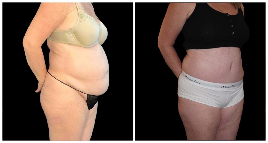 Tummy Tuck London Ontario before and after result