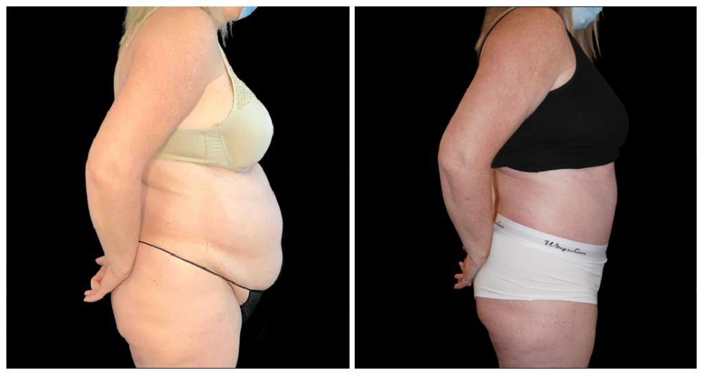 Tummy Tuck London Ontario before and after result