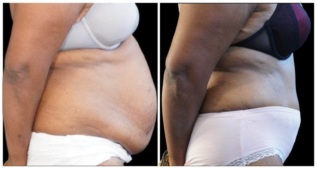Tummy Tuck London Ontario before and after result