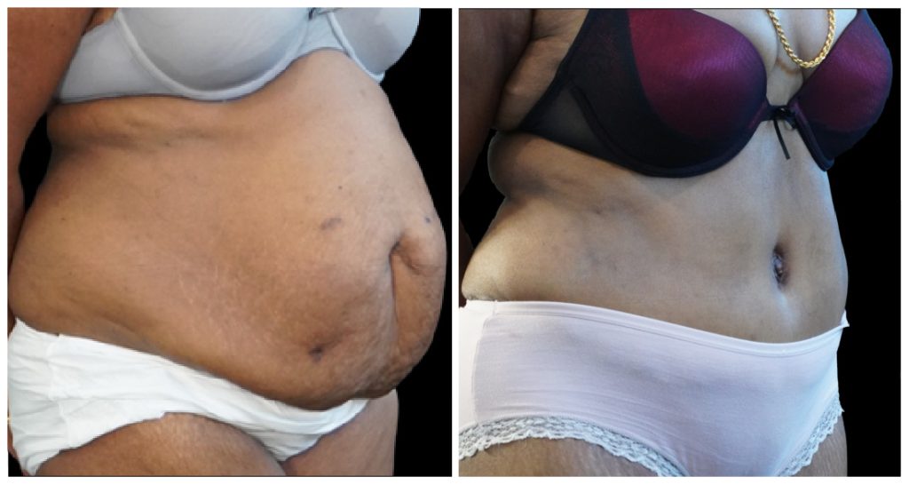 Tummy Tuck London Ontario before and after result