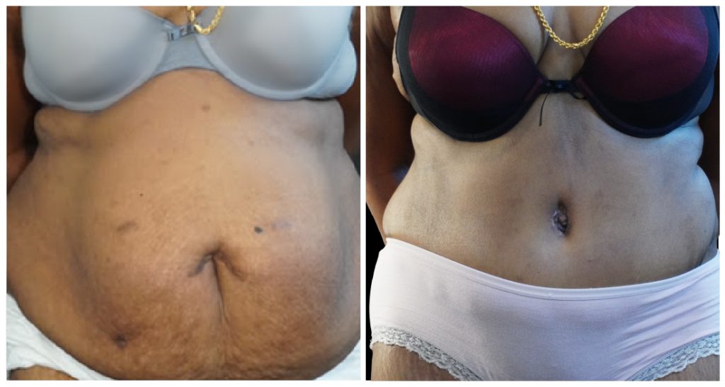 Tummy Tuck London Ontario before and after result
