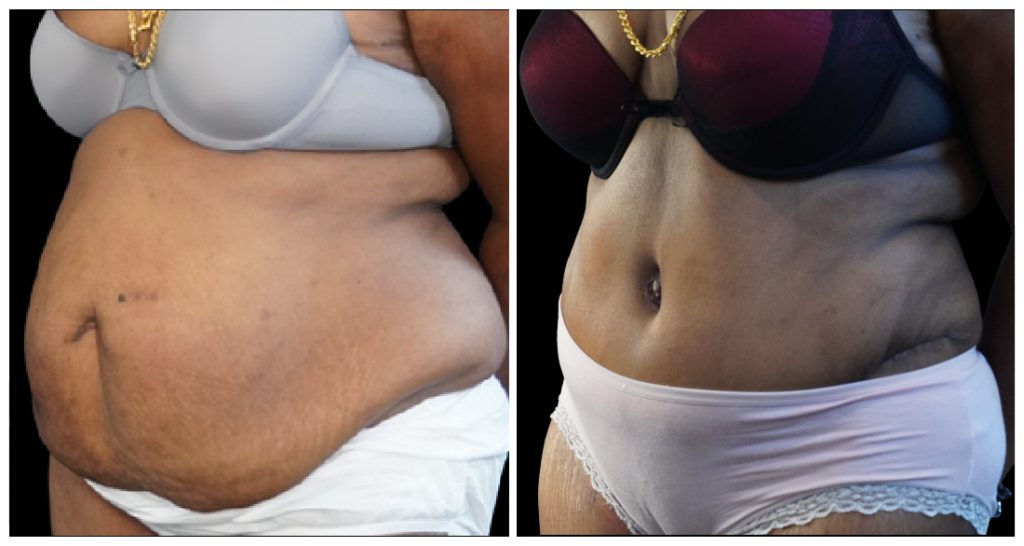 Tummy Tuck London Ontario before and after result