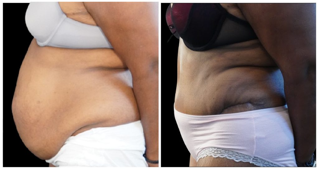Tummy Tuck London Ontario before and after result