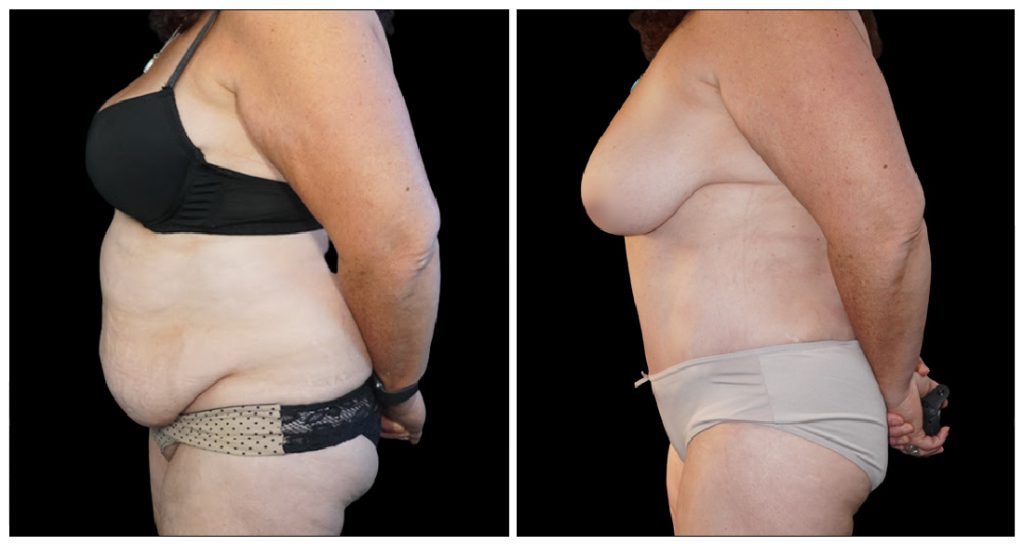 Tummy Tuck London Ontario before and after result