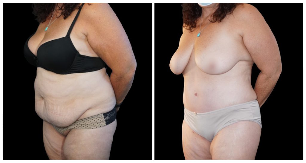 Tummy Tuck London Ontario before and after result