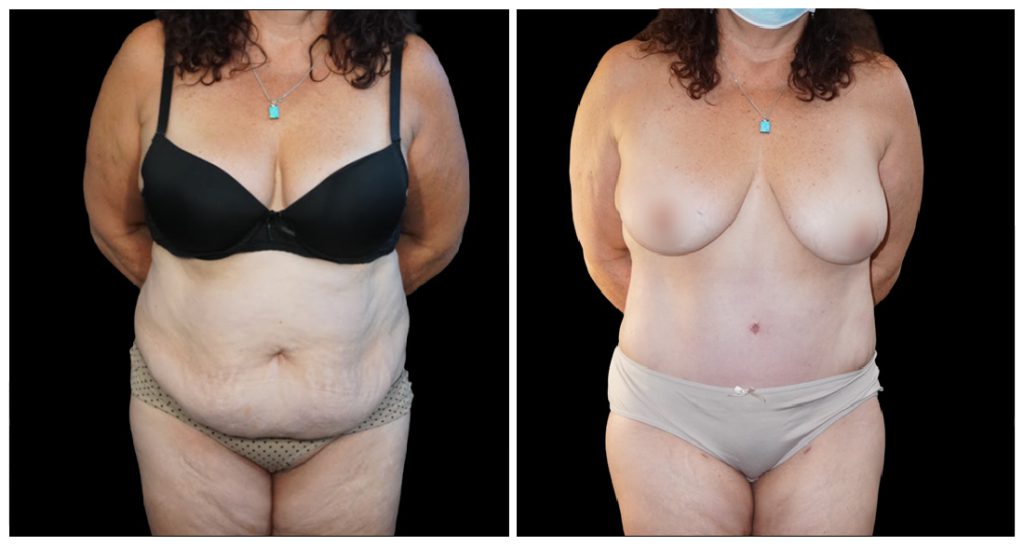 Tummy Tuck London Ontario before and after result