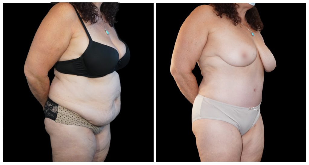 Tummy Tuck London Ontario before and after result