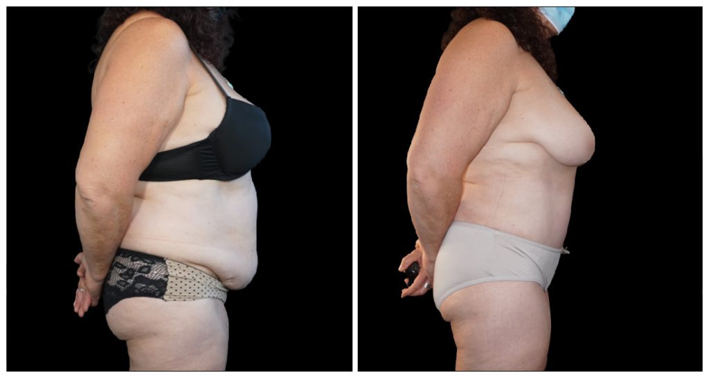 Tummy Tuck London Ontario before and after result