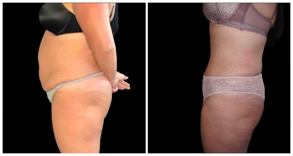 Tummy Tuck London Ontario before and after result