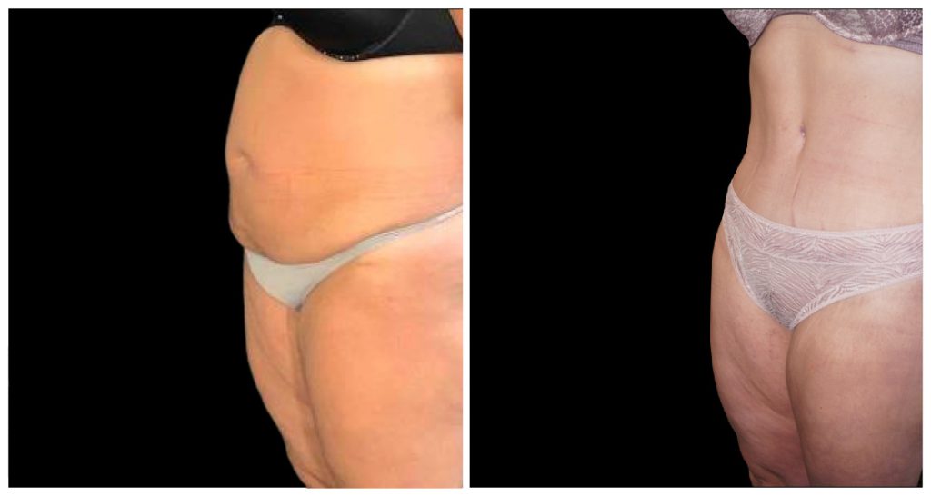 Tummy Tuck London Ontario before and after result