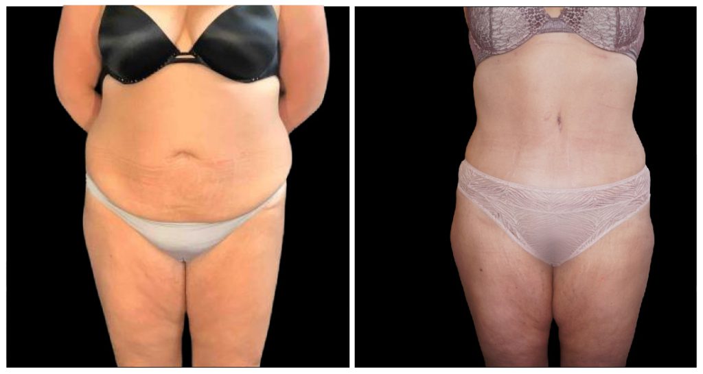 Tummy Tuck London Ontario before and after result