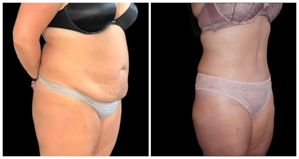 Tummy Tuck London Ontario before and after result