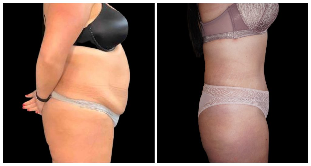 Tummy Tuck London Ontario before and after result